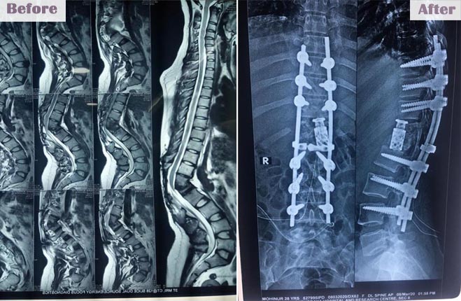 brainandspinecareindia slide2