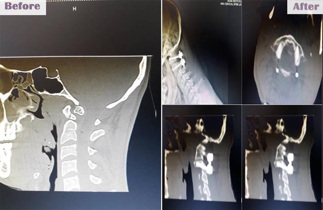 brainandspinecareindia slide4