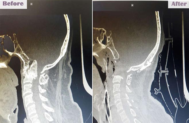 brainandspinecareindia slide6