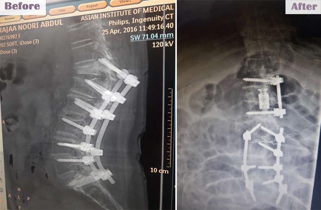 brainandspinecareindia slide7