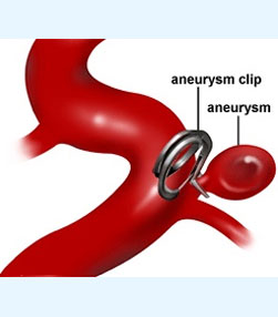 Aneurysm Clipping