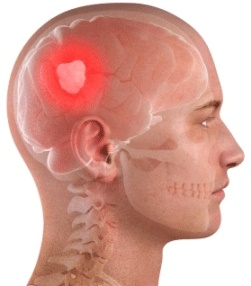 Brain Tumor Surgery & Treatment