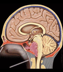 Endoscopic & endoscope assisted brain surgery