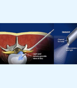 Endoscopic Surgery