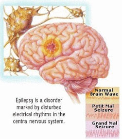Epilepsy Surgery
