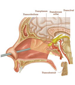 Expanded Endonasal Surgery